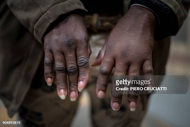 Migrant shows a swollen hand exposed to low temperatures during an attempt to cross the border between Italy and France, in Bardonecchia on January...