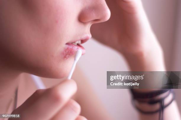 herpes - herpes zoster stock pictures, royalty-free photos & images