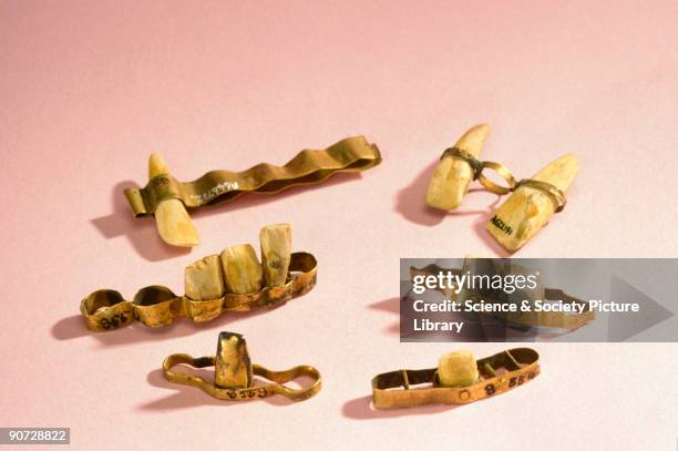 The Etruscans were the first people to make false teeth. These examples show how they mounted extracted teeth, minus their roots, on gold bridges...