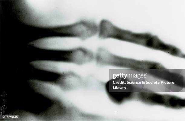 Ray photograph taken by Wilhem Conrad Roentgen , of his wife's hand in December 1895 . Roentgen was Professor of Physics at the University of...