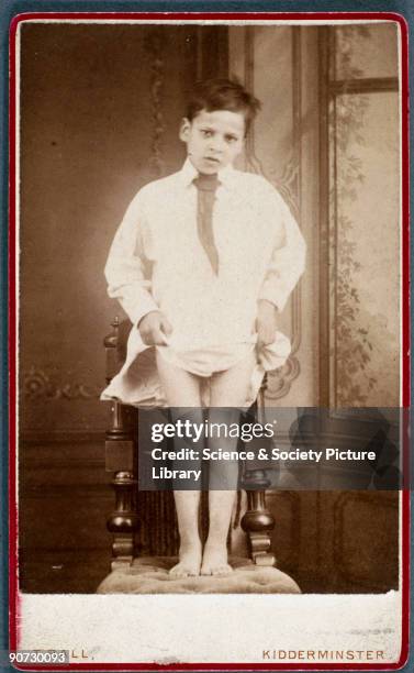Black Rickets Rickets Disease Photos and Premium High Res Pictures - Getty Images