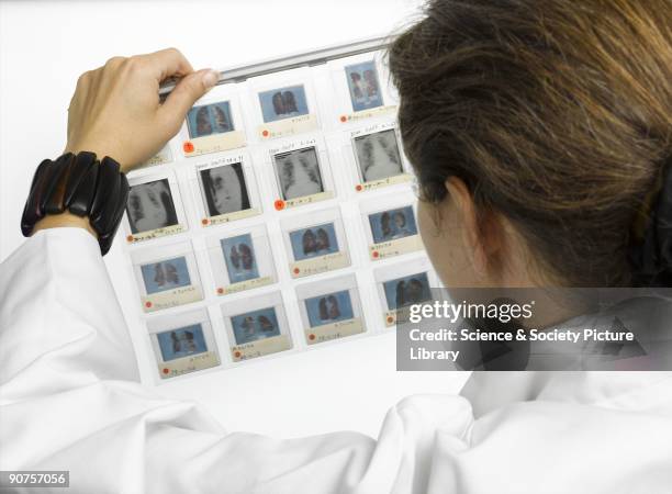 Hanging file of transparencies created by the pathologist Dr P C Elmes to accompany his lectures on lung diseases. The slides include photographs of...