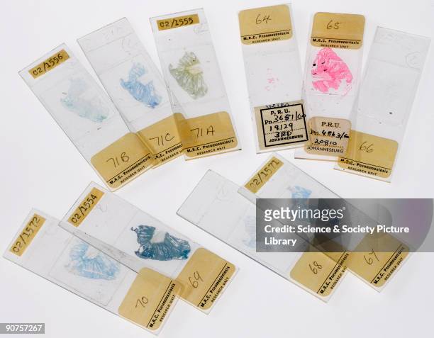 Samples of lung tissue from A N V, a 50 year-old white male, born in Griquatown, South Africa. In 1914, aged 8, he worked in an asbestos mine for a...