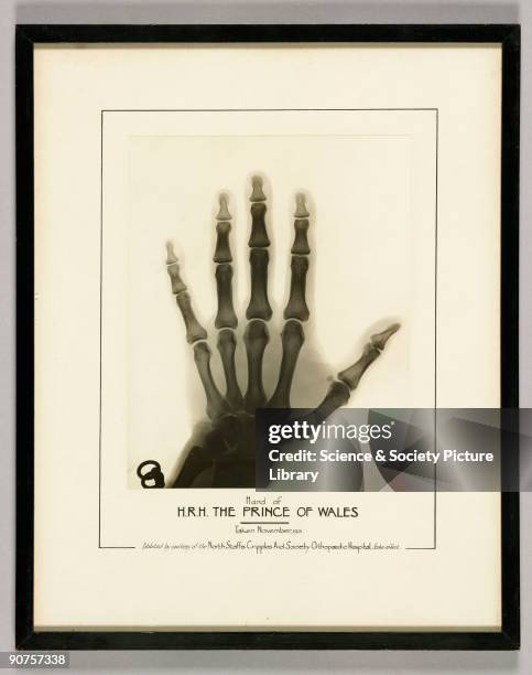 Photographic print of an X-ray of the hand of the Prince of Wales, later Edward VIII, taken in November 1931, almost certainly at The North Staffs...