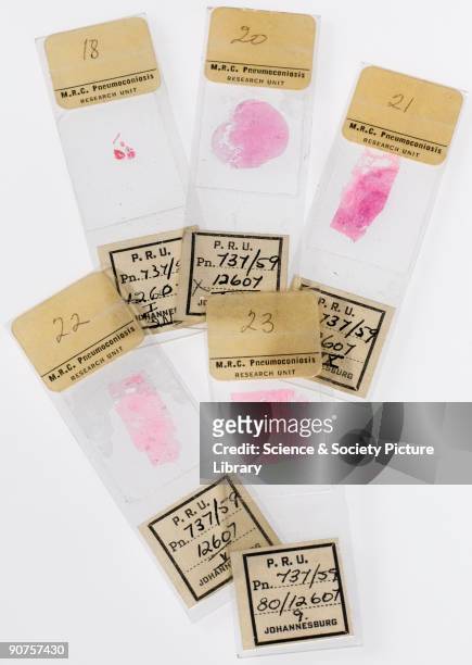 Samples of lung tissue from S S, a 40 year-old Bantu male, born in the Kuruman district of South Africa, where as a child he often played on the...