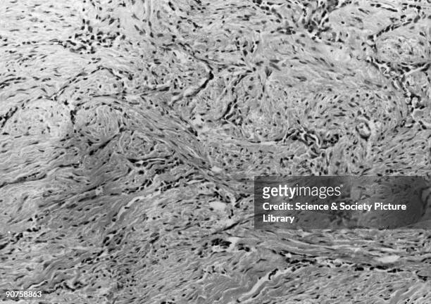 The cell structure of lung tissue affected by the cancer mesothelioma, magnified from a microscope slide prepared by pathologist Dr J C Wagner....