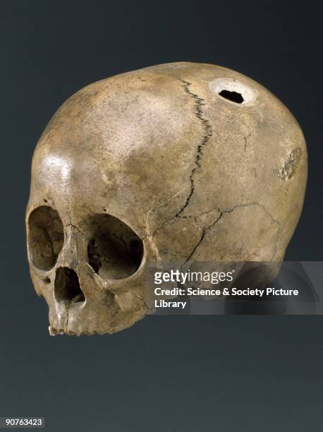 Human skull with 2 trephinations in the parietal bones, one with an excised rondelle hinged in place. Part of Dr T Wilson Parry's collection,...