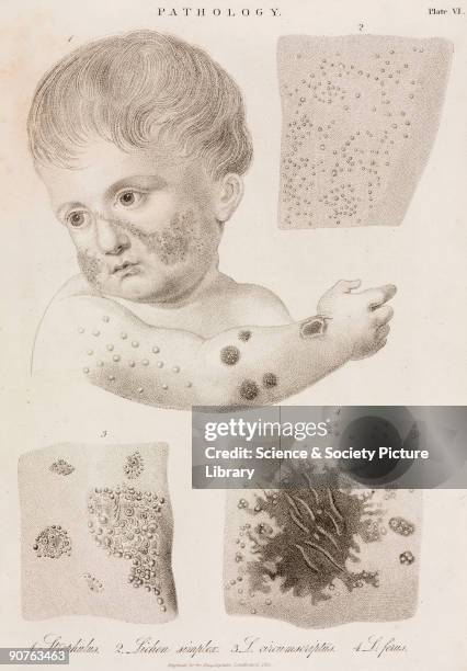 Engraving showing: Strophulus, , a disease especially common among children, characterized by an eruption of papules on the skin; Lichen simplex, ,...