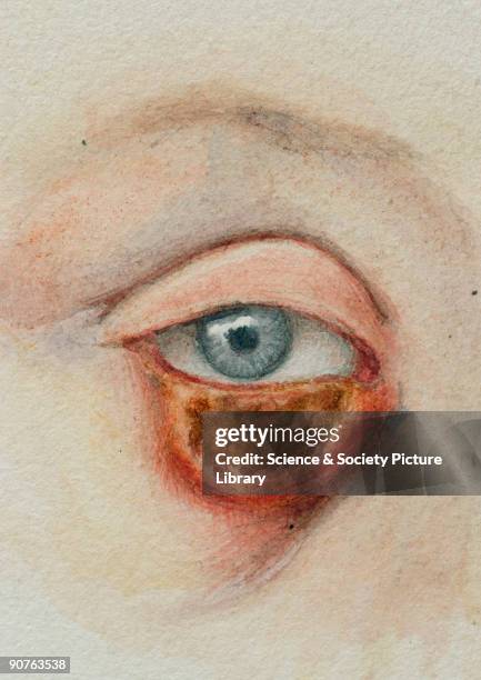 Watercolour illustration on card by Peter Nairn of syphilitic condition of lower eyelid.