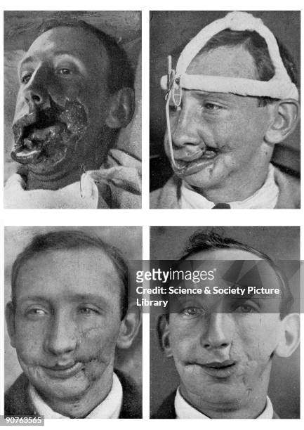 Four photographs documenting the facial reconstruction of a soldier whose cheek was extensively wounded during the Battle of the Somme . Taken from...