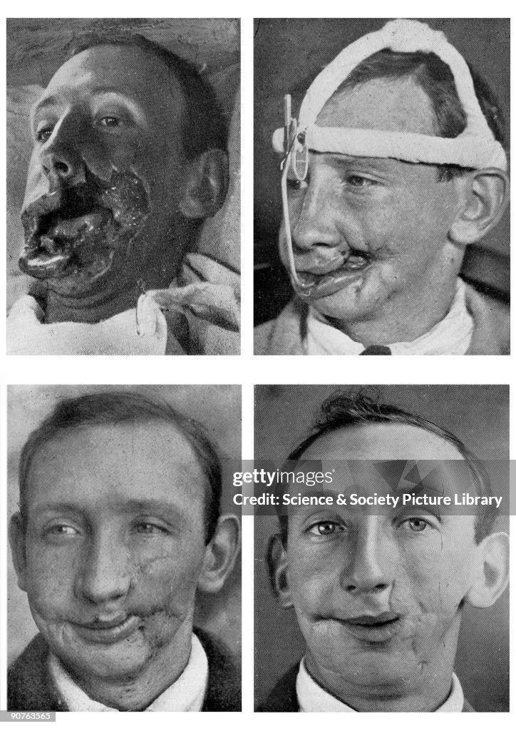 Four views of facial reconstruction after a war wound, July 1916.