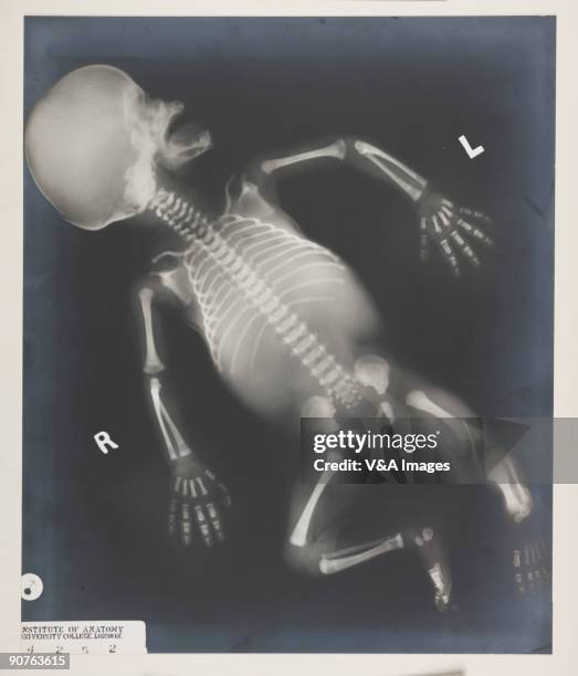 Ray of a male baby, from the Institute of Anatomy at University College, London. In 1895, German physicist Wilhelm Konrad Roentgen discovered X-rays...