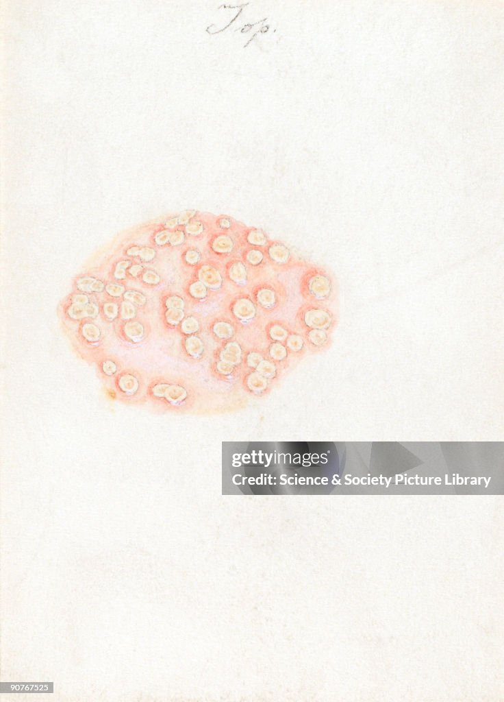 Smallpox lesions on the skin, 16 February 1901.