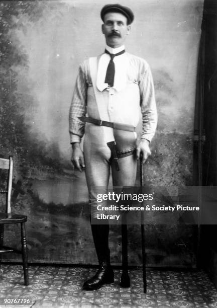 Studio photograph of a man wearing an artificial leg. The peg-leg was manufactured by James Gillingham , a boot- and shoemaker based in Chard,...
