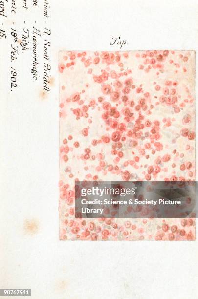 From a collection of 15 watercolour illustrations of pox lesions in human skin, consisting mostly of smallpox with the exception of one chickenpox....