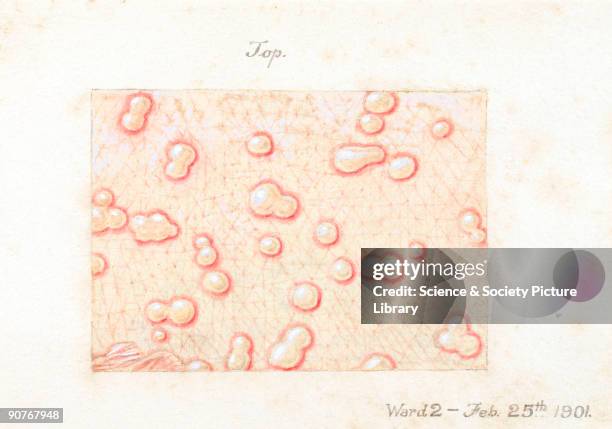 One of a collection of 15 watercolour illustrations of pox lesions in human skin, consisting mostly of smallpox with the exception of one chickenpox....