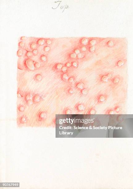 One of a collection of 15 watercolour illustrations of pox lesions in human skin, consisting mostly of smallpox with the exception of one chickenpox....