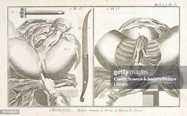 Plate 13 showing two surgical instruments and anatomical diagrams of the perineum and the muscles of the perineum. From the 1780 quarto edition of...