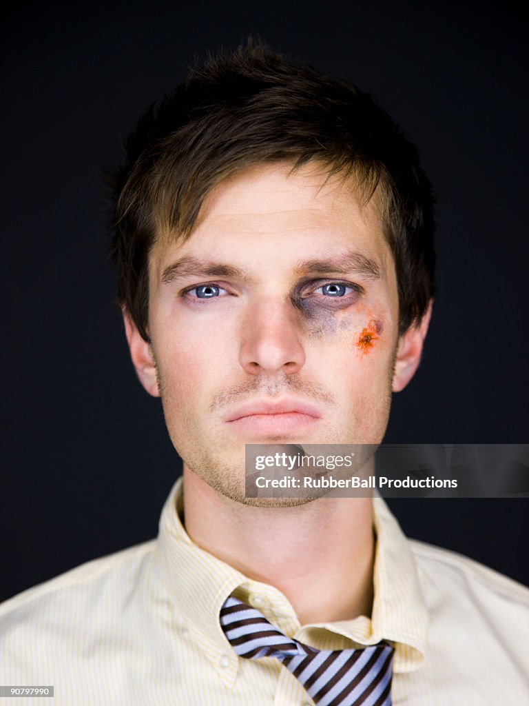 Man with a black eye