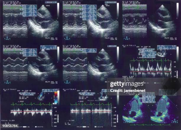 echo en el electrocardiograma - ecografía fotografías e imágenes de stock