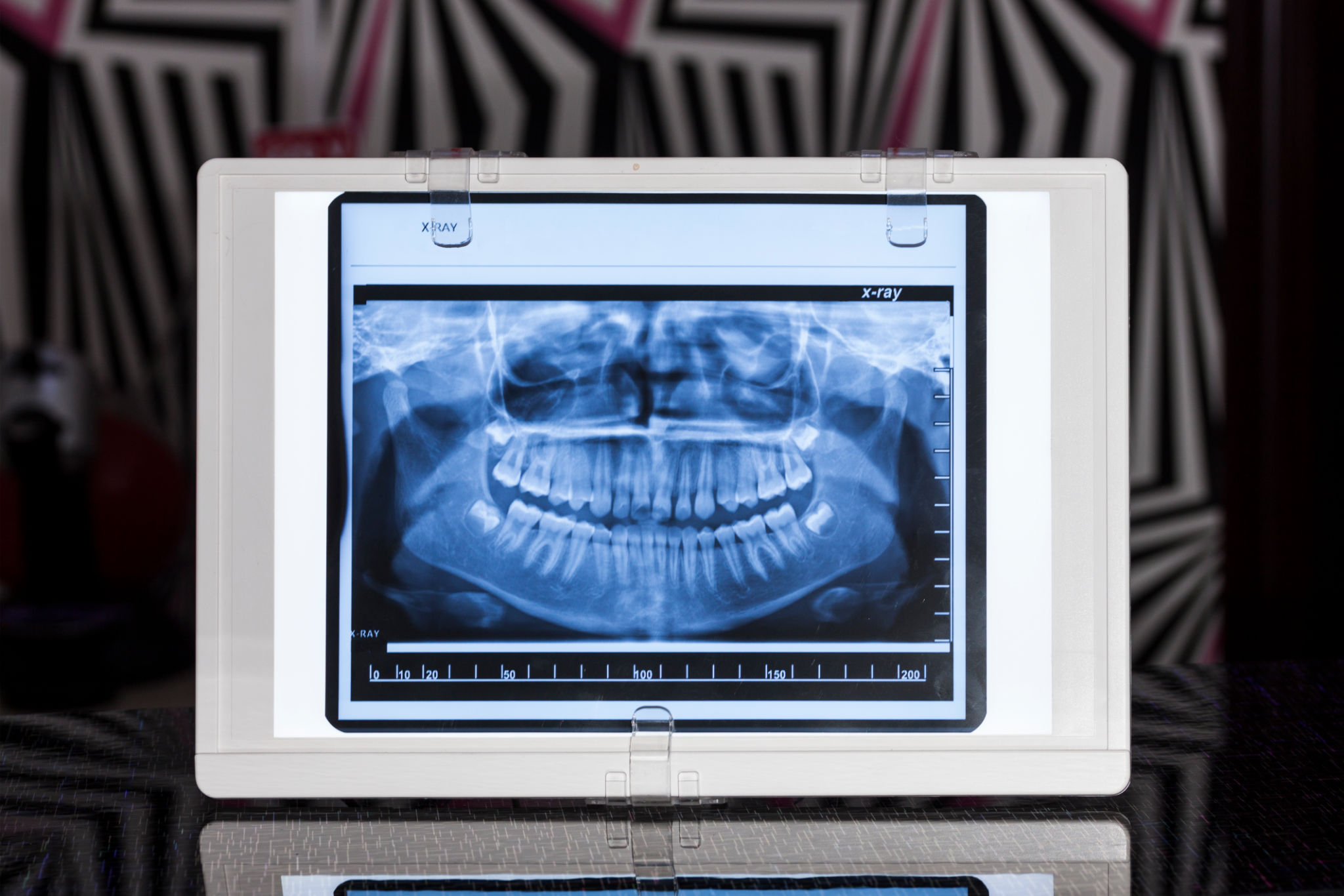 wisdome teeth x-ray