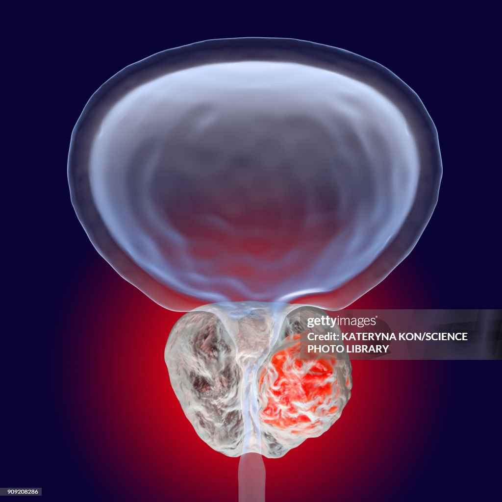 Prostate cancer illustration