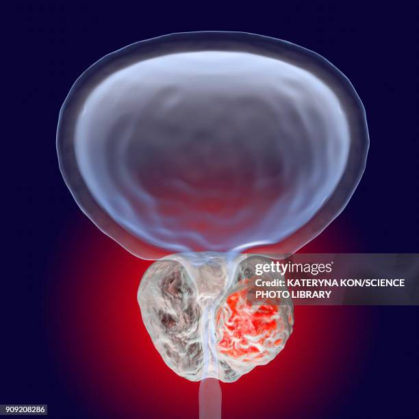 prostate cancer illustration - prostate cancer stock illustrations