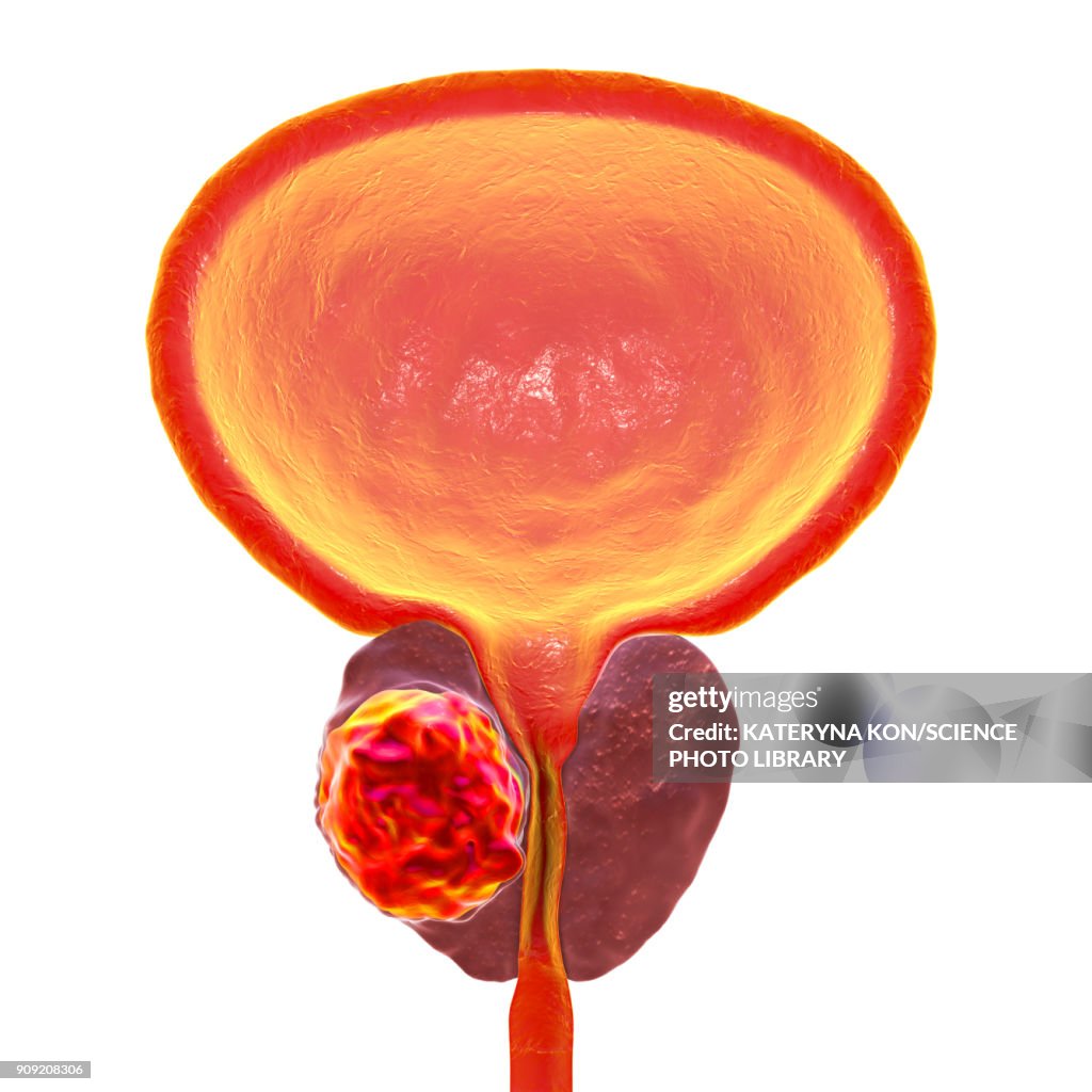 Prostate cancer, illustration