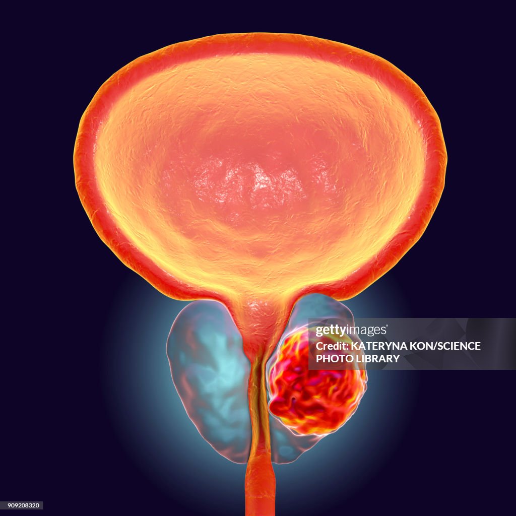 Prostate cancer, illustration