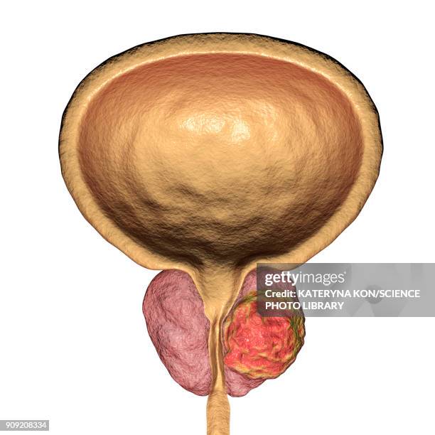 ilustrações, clipart, desenhos animados e ícones de prostate cancer illustration - genital herpes