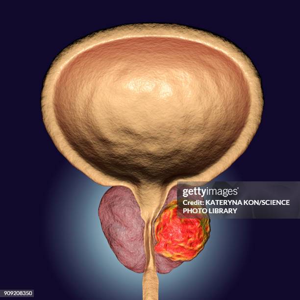 prostate cancer illustration - exokrine drüse stock-grafiken, -clipart, -cartoons und -symbole