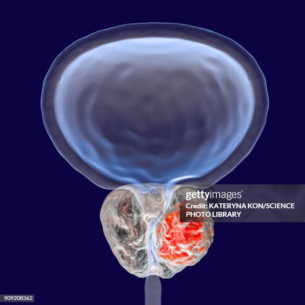 prostate cancer illustration - prostate gland stock illustrations