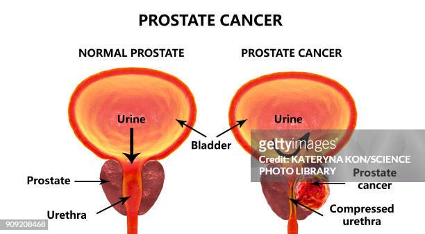 prostate cancer, illustration - prostate cancer stock illustrations