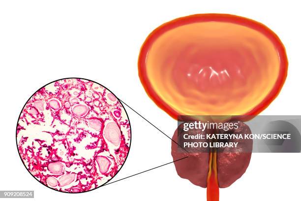 benign prostatic hyperplasia - hyperplasia stock illustrations