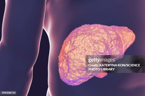 liver cirrhosis, illustration - cirrhosis 幅插畫檔、美工圖案、卡通及圖標