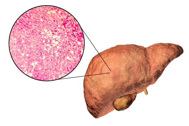 fatty liver, illustration and micrograph - 脂肪肝点のイラスト素材／クリップアート素材／マンガ素材／アイコン素材