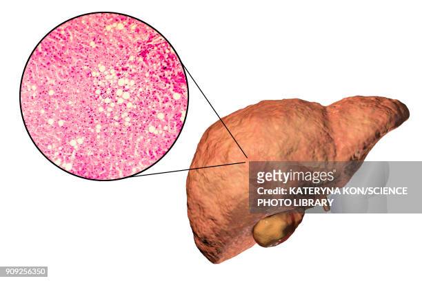 fatty liver, illustration and micrograph - adipose cell stock illustrations