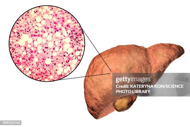 fatty liver, illustration and micrograph - 光学顕微鏡図点のイラスト素材／クリップアート素材／マンガ素材／アイコン素材