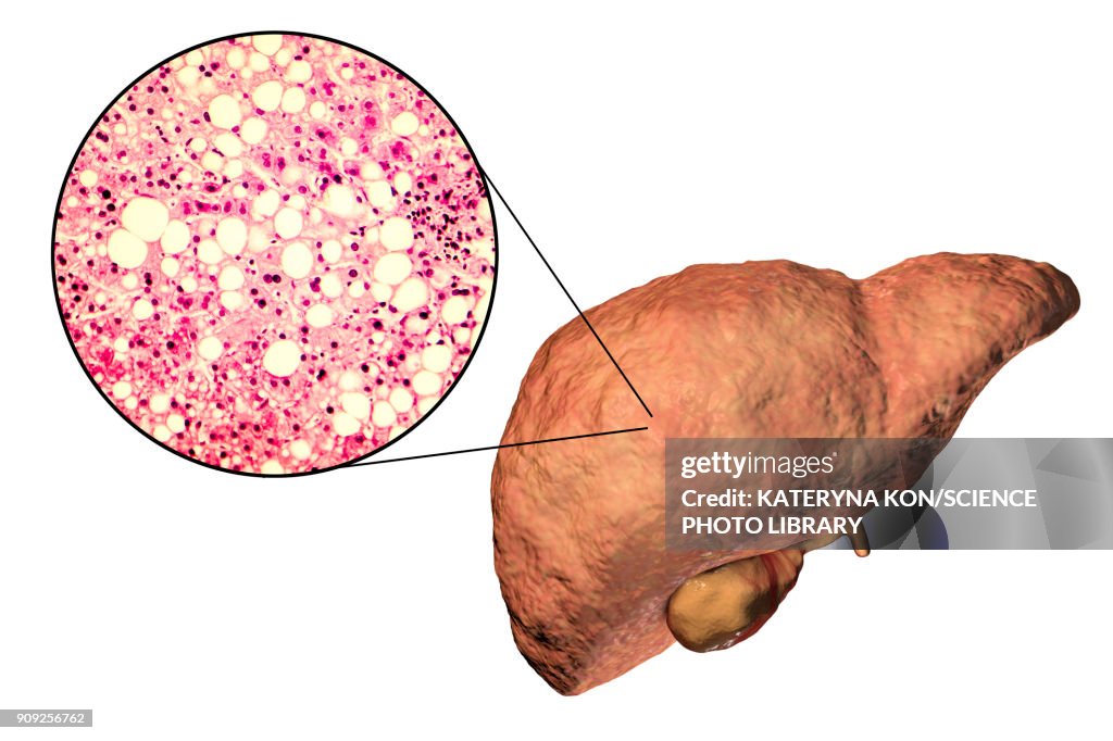 Fatty liver, illustration and micrograph