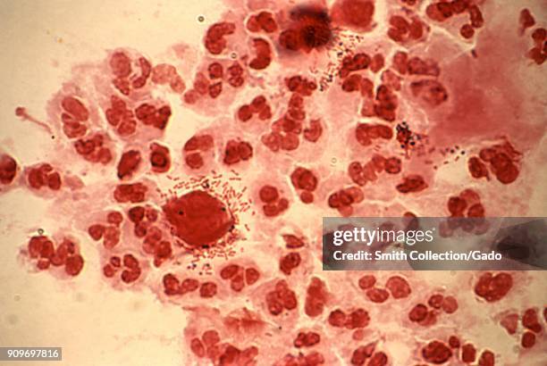 Trichomonas vaginalis, the presence of trichomonads and rods revealed in the micrograph film using Gram-stain of a urethral discharge, 1986. Image...