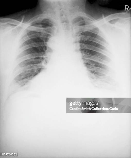 Ray image of a patient's chest with pulmonary anthrax, a 46 year old male who worked as a card tender in a goat hair processing mill, 1972. Image...