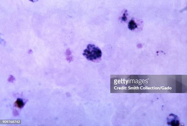 Photomicrograph of the malaria parasite Plasmodium vivax in its mature schizont phase with 20 merozoites, on thick blood smear magnified 1125x, 1965....