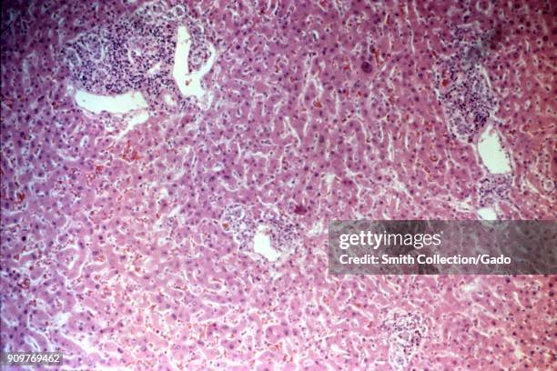 Photomicrograph of a liver section with triaditis , presence of eosinophils and cholangitis , histopathologic tissue changes occurring due to Toxic...