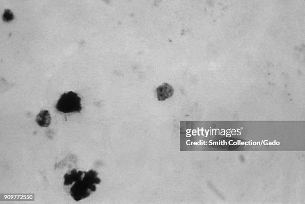 Photomicrograph of the malaria parasite Plasmodium malariae in trophozoite phase with prominent pigmentation, on a thick blood smear, 1965. Image...