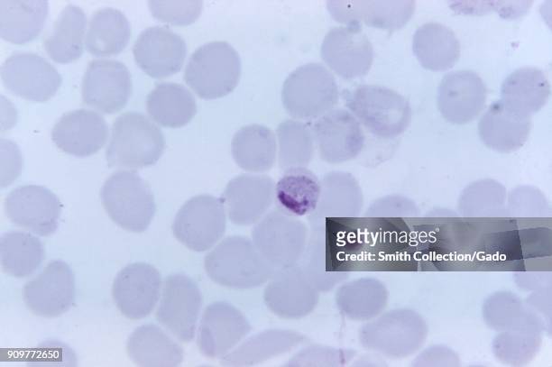 Photomicrograph of the malaria parasite Plasmodium malariae in mature trophozoite stage, on a thin blood smear with Giemsa stain, magnified 1125x,...