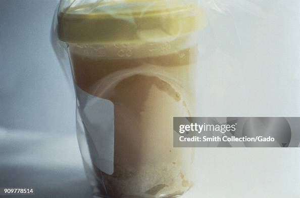 Stool Rice Water Photograph of a jar containing 'rice water', stool from a cholera ...