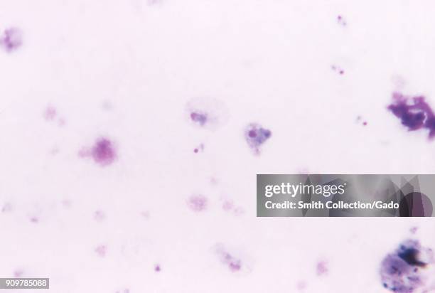 Photomicrograph of the malaria causing parasite Plasmodium vivax in its mature trophozoite phase, on a thick film blood smear with Giemsa stain,...