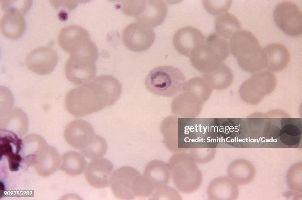 Photomicrograph of the malaria parazite Plasmodium ovale in its trophozoite phase, within a slightly oval red blood cell, on thin film blood smear,...