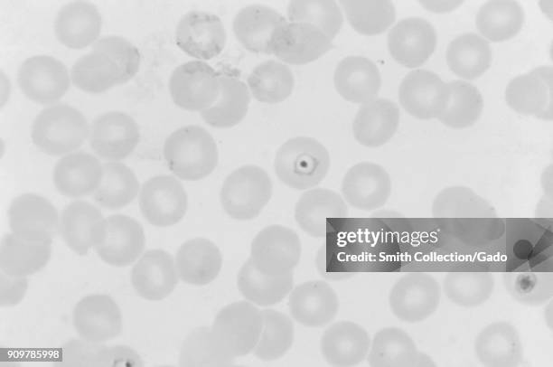 Photomicrograph of the malaria parasite Plasmodium vivax in ring phase with chromatin mass in its center, on Giemsa stained thin film, magnified...