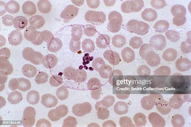 Photomicrogragh of the malaria parasite Plasmodium ovale in its mature schizont phase containing separated merozoites, magnified 1000x, 1974. Image...